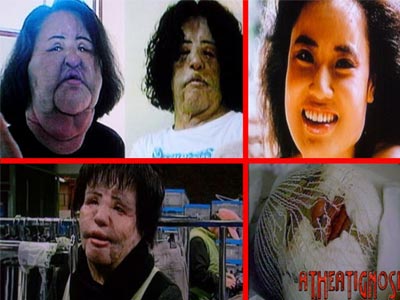 Πρώην μοντέλο παραμορφώνεται από τη σιλικόνη