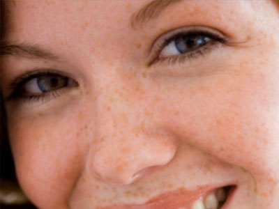 Απαλλαγείτε από τις φακίδες