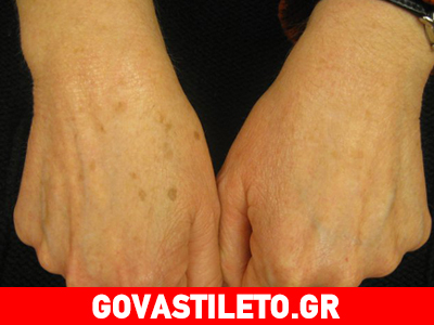 Η καλύτερη συνταγή για τις κηλίδες στη ράχη των χεριών