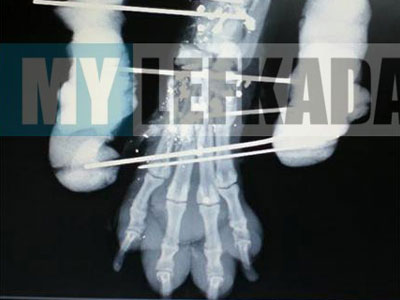 Συνεχίζει να βασανίζεται ο Γουσταύος