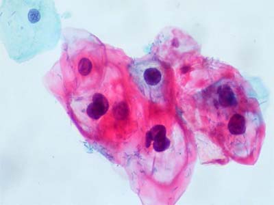 Οκτώ στελέχη του ιού HPV προκαλούν καρκίνο