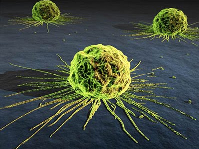 Νέα μέθοδος διάγνωσης καρκινικών όγκων