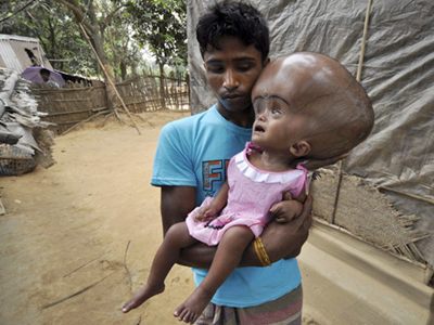 Ινδία: Έλαβε εξιτήριο η μικρή Ρούνα