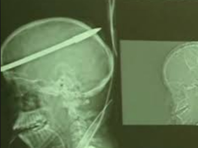 Σπάνια επέμβαση Έλληνα γιατρού στο βιβλίο Γκίνες