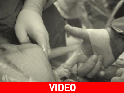 Άρπαξε το δάκτυλο του μαιευτήρα