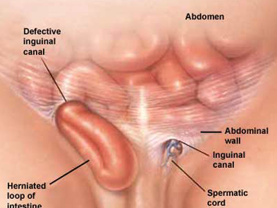 Ανώδυνη λύση για την βουβωνοκήλη