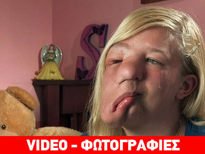 Απαλλάχτηκε από τον τεράστιο όγκο που είχε στο πρόσωπο