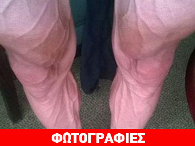 Σοκάρουν τα πόδια ποδηλάτη μετά τον Γύρο της Γαλλίας