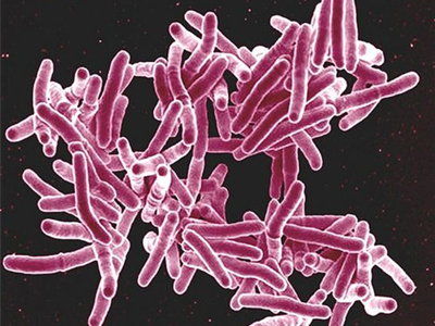 Επιβεβαιώθηκε κρούσμα φυματίωσης στο λύκειο της Σπάρτης