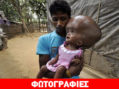 Απίστευτη η αλλαγή του κοριτσιού με το τεράστιο κεφάλι Απίστευτη η αλλαγή του κοριτσιού με το τεράστιο κεφάλι