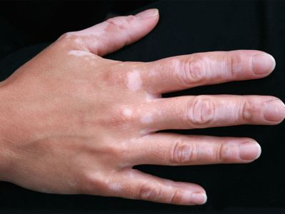 Τι πρέπει να γνωρίζουμε για την λεύκη