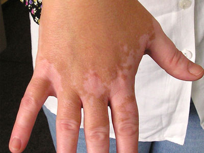 Νέα μέθοδος θεραπείας της λεύκης