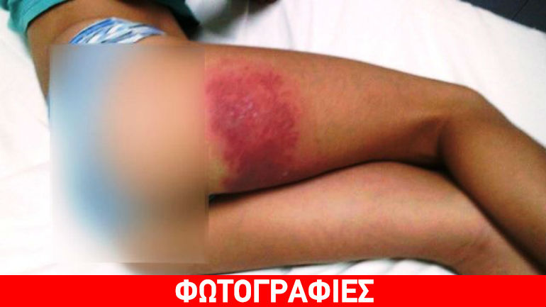 Από την παραλία στο νοσοκομείο έπειτα από «τσίμπημα» θαλάσσιας ανεμώνης