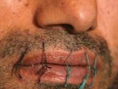 Έραψαν τα στόματα τους