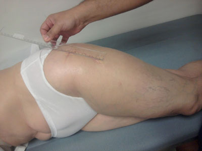 Σκάνδαλο με τοξικά μέταλλα σε εμφυτεύματα ισχίου