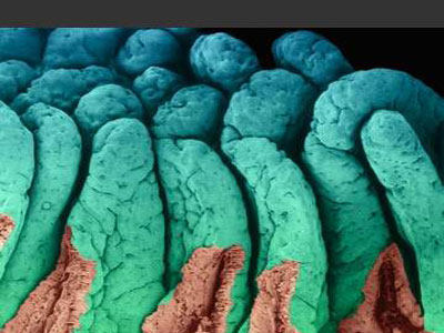 Αυξάνονται οι θάνατοι από το βακτήριο Ε.Coli