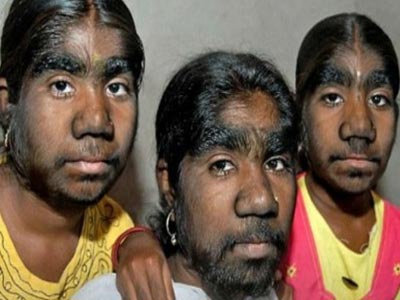 Πάσχουν από το σύνδρομο του λυκανθρώπου!