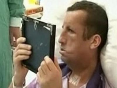 Τουρκία: 19χρονος αντικρίζει το νέο του πρόσωπο!