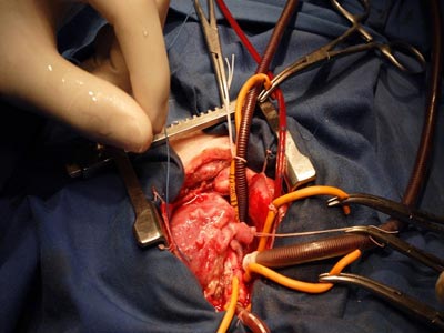 Η πρώτη τεχνητή καρδιά σε άνθρωπο είναι πραγματικότητα