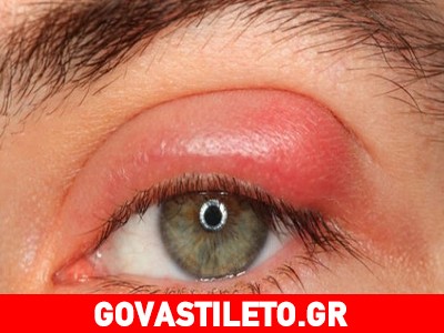 Βγάλατε κριθαράκι στο μάτι; Πώς φεύγει και τι να κάνετε