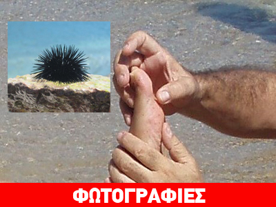 Τι να κάνετε αν πατήσετε αχινό