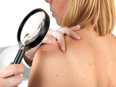 Οι γυναίκες ξεπερνούν ευκολότερα το μελάνωμα;