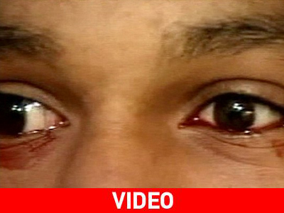 Δάκρυα από αίμα από τα μάτια 15χρονου