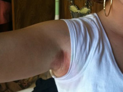 Ποια διάσημη κάηκε από αποσμητικό;