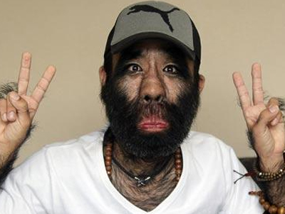 Επέμβαση για να σωθεί από την τριχοφυΐα