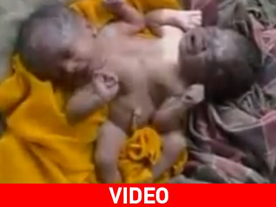 Σιαμαία γεννήθηκαν στην Ινδονησία