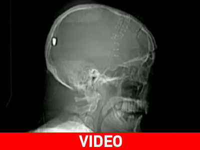 Του σφηνώθηκε σφαίρα στο κεφάλι ενώ φρόντιζε τον κήπο του