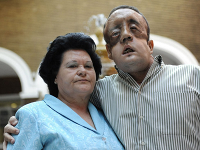 Ο άνθρωπος που έκανε μερική μεταμόσχευση προσώπου