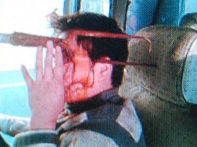 Σοκ: Τον τρύπησε δίκρανο στο πρόσωπο