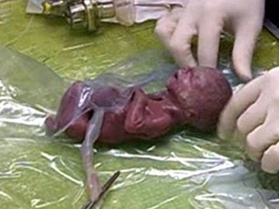 Επέζησε νεογέννητο βάρους 275 γραμμαρίων