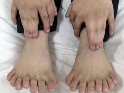 Παιδί με 31 δάχτυλα θα κάνει διορθωτική εγχείρηση