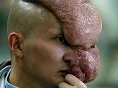 Απίστευτη περίπτωση «ανθρώπου-ελέφαντα» στην Κίνα