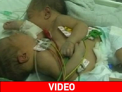 Δύσκολες στιγμές για σιαμαία στη Γάζα