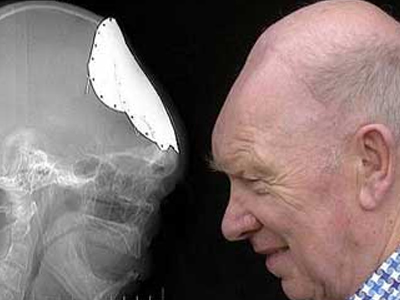 Ο άνθρωπος που «φύτρωσε»… νέο κρανίο