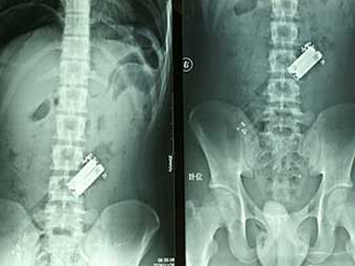 Γιατρέ έχασα το τηλεκοντρόλ