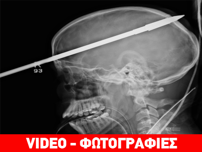 Βέργα ψαροτούφεκου καρφώθηκε στο κεφάλι 16χρονου Βέργα ψαροτούφεκου καρφώθηκε στο κεφάλι 16χρονου
