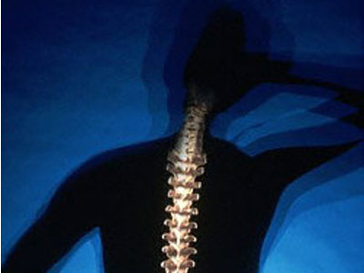 Nέο φάρμακο κατά της οστεοπόρωσης