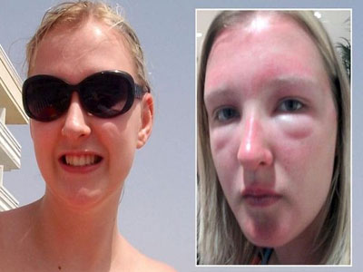 Παραμορφώθηκαν τα μάτια της εξαιτίας μαϊμού γυαλιών ηλίου!