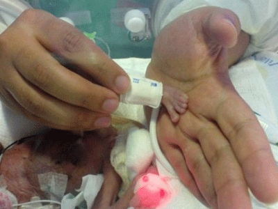 Βραζιλία: Γεννήθηκε 340 γραμμάρια και τελικά επέζησε…