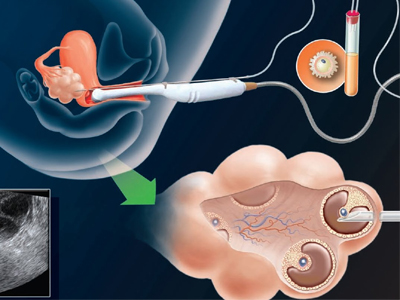 Εξωσωματική γονιμοποίηση χωρίς φαρμακευτική αγωγη-2ο Στάδιο: Ωοληψία