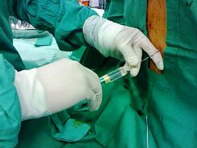 Γονιμότητα: Επισκληρίδιος στον τοκετό: Ναι ή όχι;