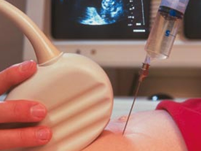 Γονιμότητα: Είναι πιθανή η αμνιοκέντηση;