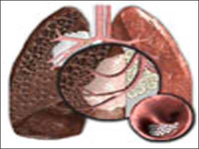 SEXUALITY: Έχω Χρόνια Αποφρακτική Πνευμονοπάθεια και μου έχουν παρουσιαστεί διάφορα προβλήματα…