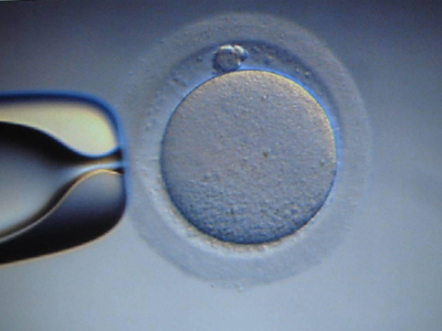 Γονιμότητα: Εξωσωματική γονιμοποίηση χωρίς φαρμακευτική αγωγή- 4ο Στάδιο: Εμβρυομεταφορά