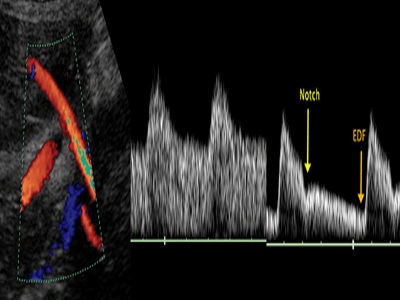 SEXUALITY: Εξέταση ντόπλερ των πεϊκών αρτηριών