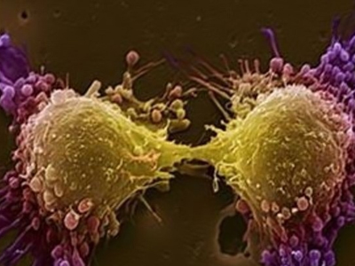 SEXUALITY: Κιρσοκήλη εναντίον του καρκίνου του προστάτη